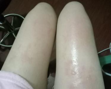 大腿上有疤吉凶 膝盖有疤风水