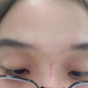鼻梁上突然出现红痕是吉凶 鼻梁有红印的预兆